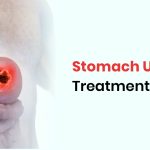 Stomach Ulcers Treatment in Delhi: Best Doctor, Medicines, and Diet Plan