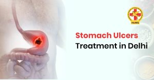 stomach ulcers treatment in Delhi