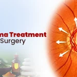 Glaucoma Treatment Without Surgery: Is It Possible?