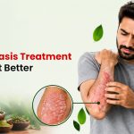 Best Psoriasis Treatment to Support Better Skin Care