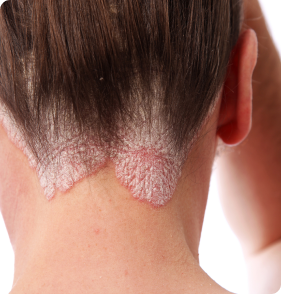 Psoriasis