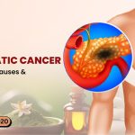 Pancreatic Cancer: Symptoms, Causes & Treatment