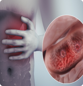 Ulcer