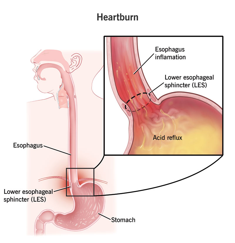 heartburn
