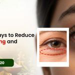 Simple Ways to Reduce Eye Swelling and Puffiness
