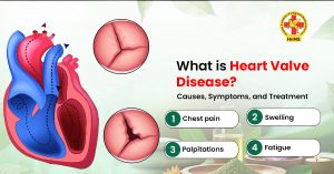 What Is Heart Valve Disease Causes, Symptoms, and Treatment