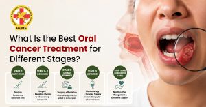 What-Is-the-Best-Oral-Cancer-Treatment-for-Different-Stages