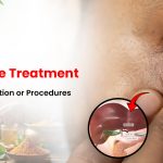 Jaundice Treatment in Sikar