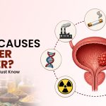 What Causes Bladder Cancer? Risk Factors You Must Know