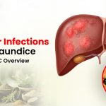 Jaundice Treatment in Surat