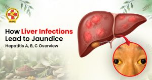 Jaundice Treatment in Surat