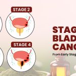 Stages of Bladder Cancer: From Early Stage to Advanced