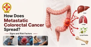 What Is Metastatic Colorectal Cancer