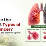 What Are the Different Types of Lung Cancer? Symptoms, Causes, and Treatment Options