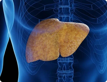 Fatty liver