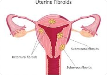 Infertility