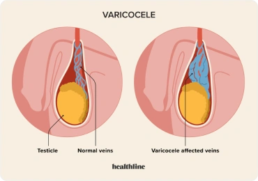 Infertility